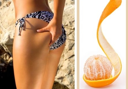 What is cellulite or orange peel skin? 