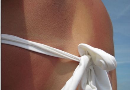 Mythes autour du soleil - un coup de soleil ne laisse aucun dégât sur la peau. Vrai ou faux?
