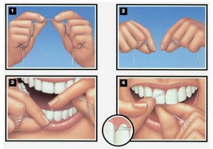 Dossier dents > Qu'est-ce que la soie dentaire? 1