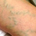 Varicose veins 2