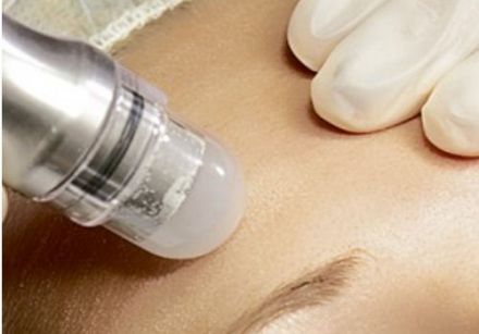 Renew your skin with microdermabrasion! 1